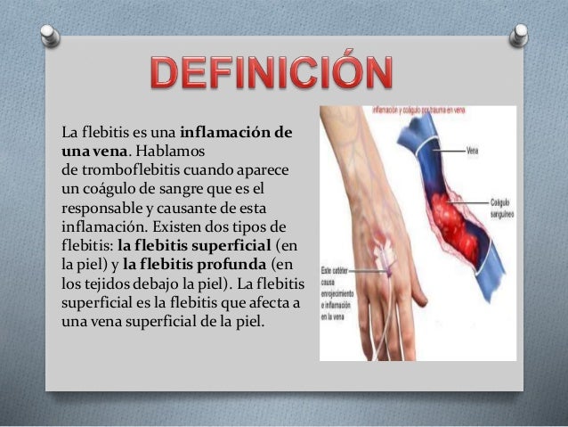 Como curar los asteriscos vasculares en los pies