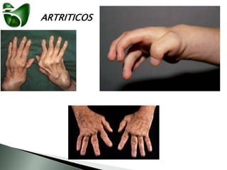 ARTRITICOS
 