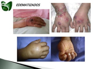 EDEMATIZADOS
 