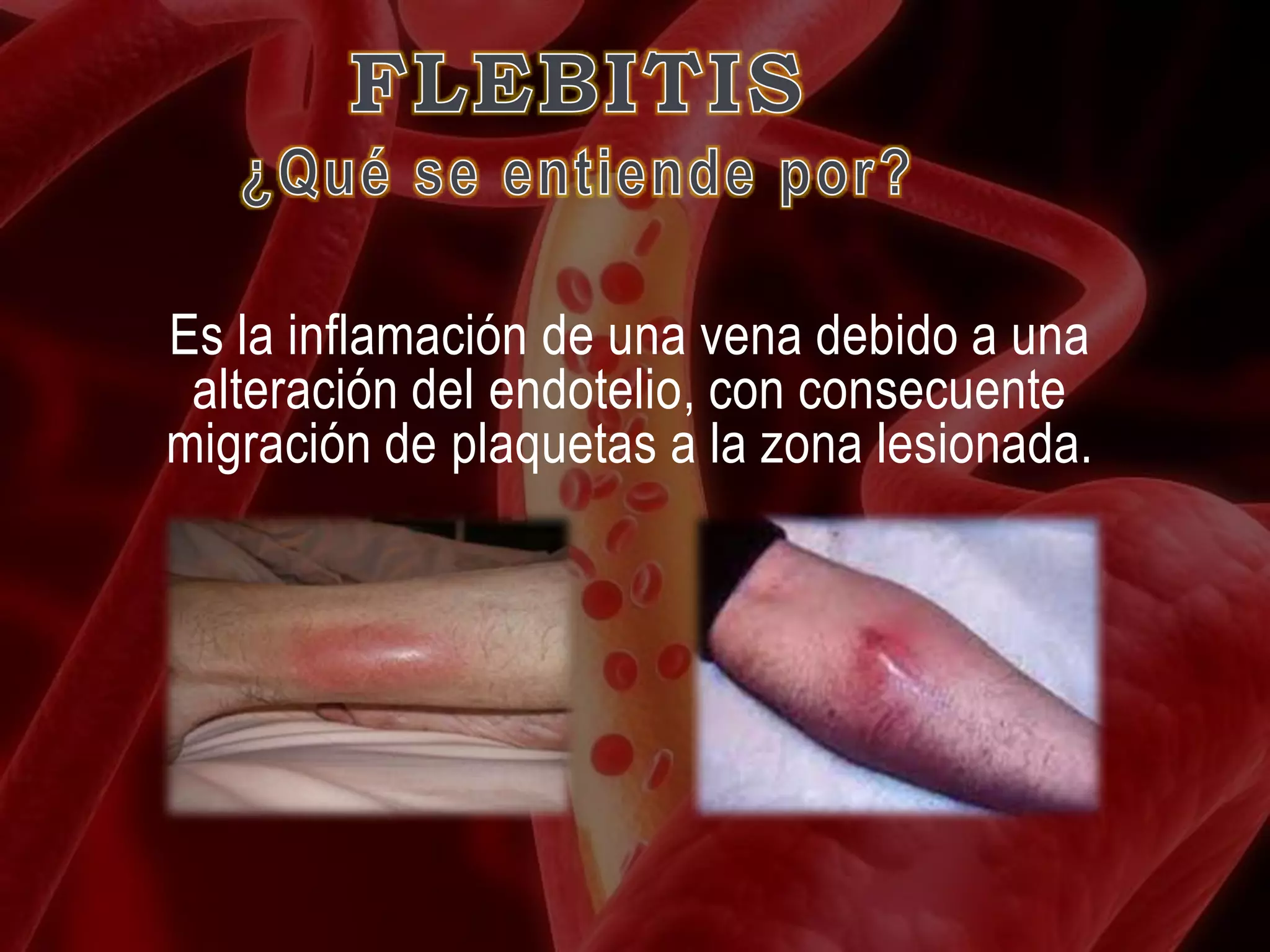 Flebitis | PPTX
