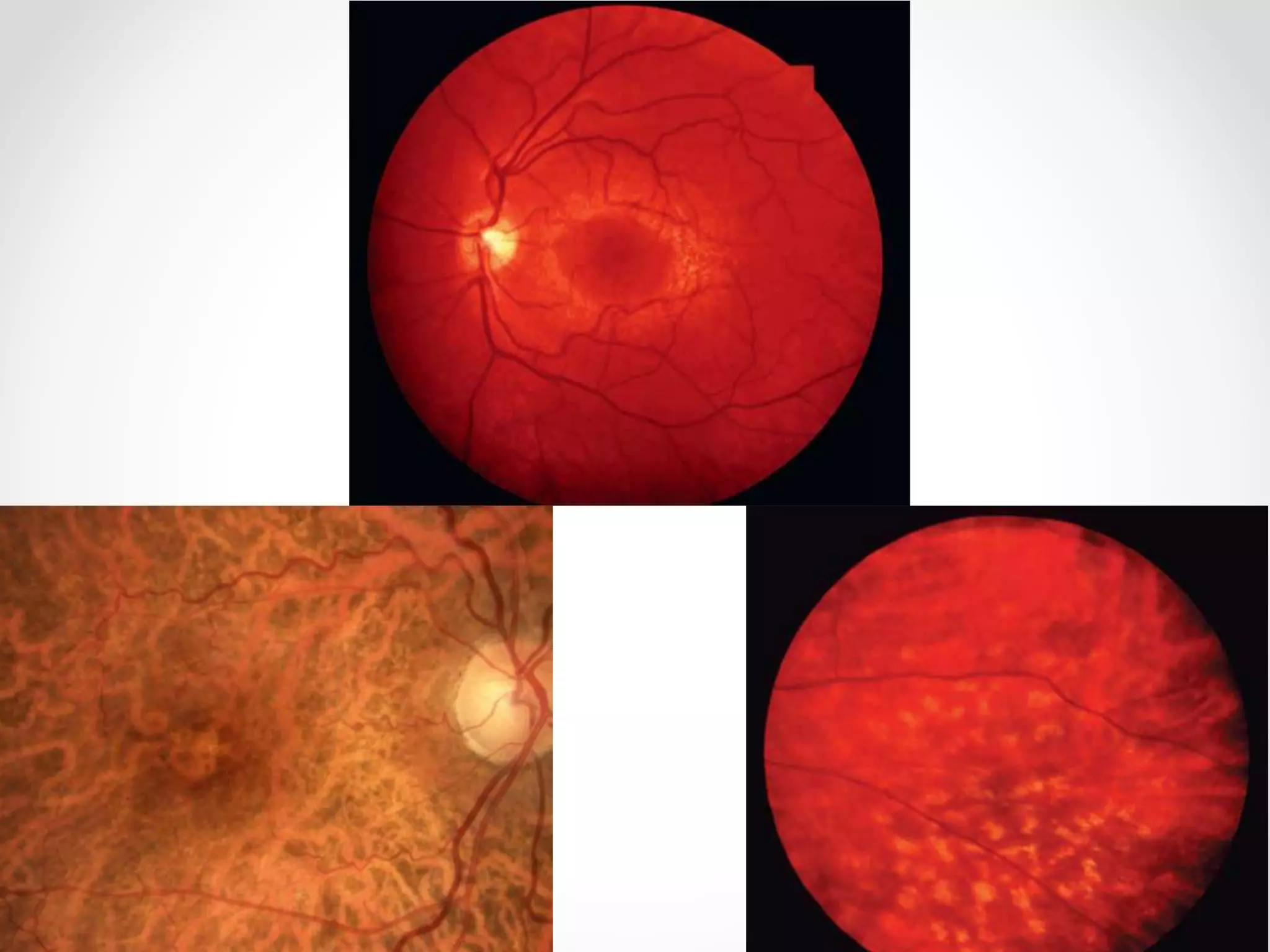 Flecks Rettine Fleck retina dr zeeshan | PPTX