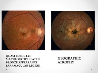 Flecks Rettine Fleck retina dr zeeshan | PPTX