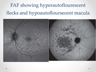 Flecks Rettine Fleck retina dr zeeshan | PPTX