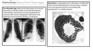 Spiculation Sign Comprehensive Radiological Insights into Pulmonary Anatomy and ...