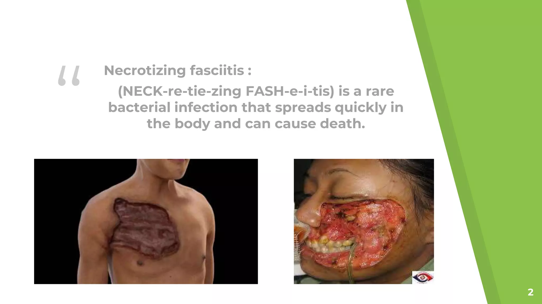 Necrotizing Fasciitis : "Life After Flesh-Eating Bacteria" by Antra ...