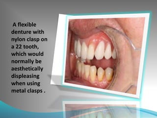 A flexible
denture with
nylon clasp on
a 22 tooth,
which would
normally be
aesthetically
displeasing
when using
metal clasps .
 