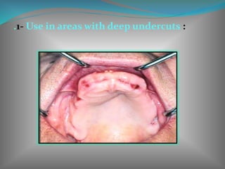 .1- Use in areas with deep undercuts :
 