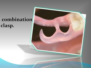 combination
clasp.
 