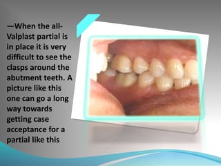 —When the all-
Valplast partial is
in place it is very
difficult to see the
clasps around the
abutment teeth. A
picture like this
one can go a long
way towards
getting case
acceptance for a
partial like this
 