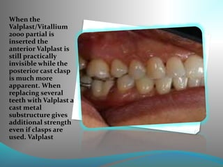 When the
Valplast/Vitallium
2000 partial is
inserted the
anterior Valplast is
still practically
invisible while the
posterior cast clasp
is much more
apparent. When
replacing several
teeth with Valplast a
cast metal
substructure gives
additional strength
even if clasps are
used. Valplast
 