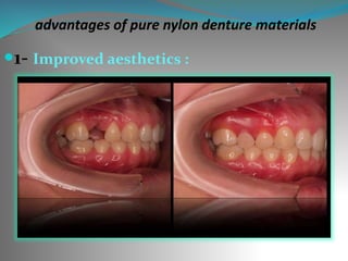 advantages of pure nylon denture materials
1- Improved aesthetics :
 
