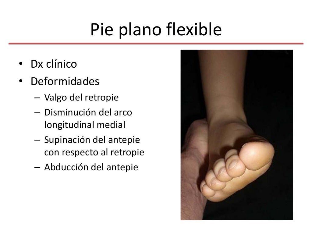 Pie plano flexible vs pie plano rigido