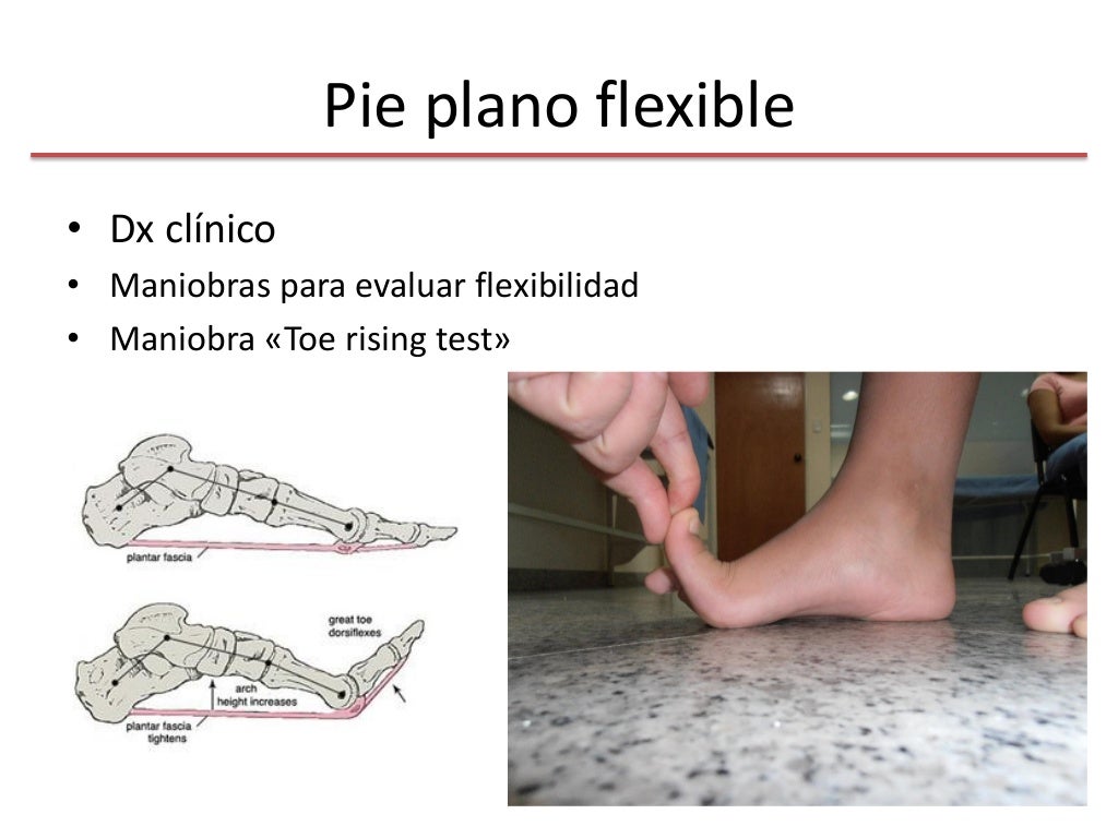Pie plano flexible vs pie plano rigido