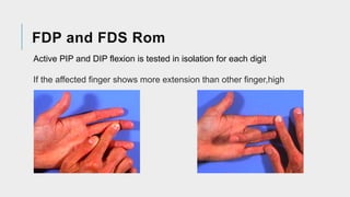 Digit Rom Guide Comprehensive Guide to Flexor and Extensor Tendon Injuries: Anatomy ...