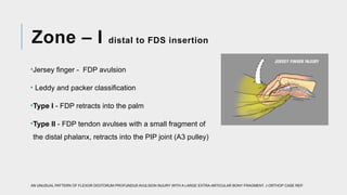 Fds Injuries Comprehensive Guide to Flexor and Extensor Tendon Injuries: Anatomy ...