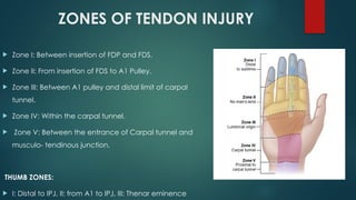 Fds Injuries Comprehensive Overview of Flexor and Extensor Tendon Injuries of the ...