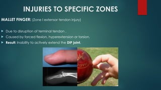 Comprehensive Overview of Flexor and Extensor Tendon Injuries of the ...