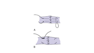 Flexor and extensor tendon injury | PPTX