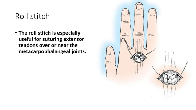 Flexor and extensor tendon injury | PPTX