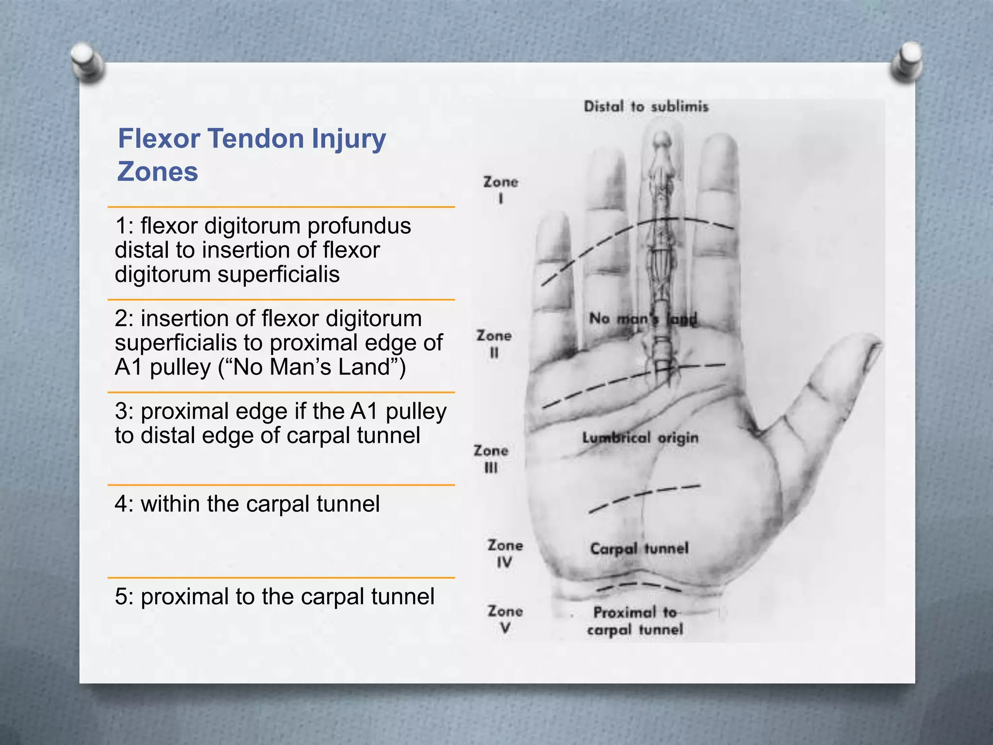 Flexor Tendon Injury
Zones
1: flexor digitorum profundus
distal to insertion of flexor
digitorum superficialis
2: insertion of flexor digitorum
superficialis to proximal edge of
A1 pulley (“No Man’s Land”)
3: proximal edge if the A1 pulley
to distal edge of carpal tunnel
4: within the carpal tunnel
5: proximal to the carpal tunnel
 