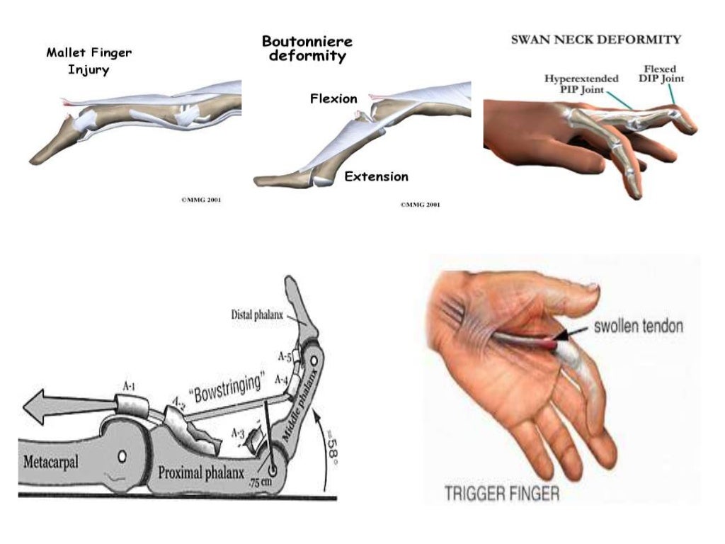 Flexor and Extensor Tendon Laceration vs. Occupational Therapy