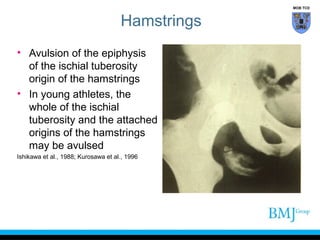 MOB TCD

Hamstrings
• Avulsion of the epiphysis
of the ischial tuberosity
origin of the hamstrings
• In young athletes, the
whole of the ischial
tuberosity and the attached
origins of the hamstrings
may be avulsed
Ishikawa et al., 1988; Kurosawa et al., 1996

 
