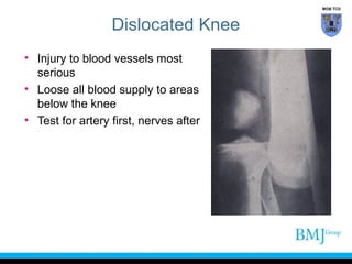 MOB TCD

Dislocated Knee
• Injury to blood vessels most
serious
• Loose all blood supply to areas
below the knee
• Test for artery first, nerves after

 