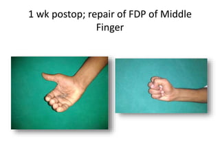 FLEXOR TENDON injury, fds,fdp,tendon injury | PPTX