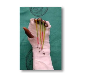 Fds Injuries FLEXOR TENDON injury, fds,fdp,tendon injury | PPTX