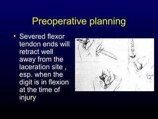 Preoperative planning
• Severed flexor
tendon ends will
retract well
away from the
laceration site ,
esp. when the
digit is in flexion
at the time of
injury

 