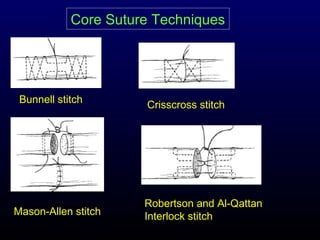 Core Suture Techniques

Bunnell stitch

Mason-Allen stitch

Crisscross stitch

Robertson and Al-Qattan
Interlock stitch

 