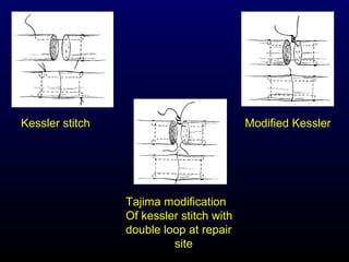 Kessler stitch

Modified Kessler

Tajima modification
Of kessler stitch with
double loop at repair
site

 