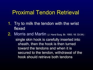 Proximal Tendon Retrieval
1. Try to milk the tendon with the wrist
flexed
2. Morris and Martin (J. Hand Surg. Br. 1993; 18: 33-34) :
single skin hook is carefully inserted into
sheath, then the hook is then turned
toward the tendons and when it is
secured to the tendon, withdrawal of the
hook should retrieve both tendons

 