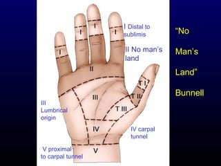 I Distal to
sublimis

II No man’s
land

“No
Man’s
Land”
Bunnell

III
Lumbrical
origin
IV carpal
tunnel
V proximal
to carpal tunnel

 