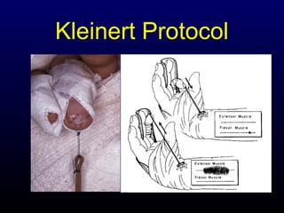 Kleinert Protocol

 