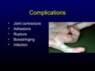 Complications
•
•
•
•
•

Joint contracture
Adhesions
Rupture
Bowstringing
Infection

 