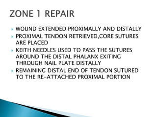  WOUND EXTENDED PROXIMALLY AND DISTALLY
 PROXIMAL TENDON RETRIEVED,CORE SUTURES
ARE PLACED
 KEITH NEEDLES USED TO PASS THE SUTURES
AROUND THE DISTAL PHALANX EXITING
THROUGH NAIL PLATE DISTALLY
 REMAINING DISTAL END OF TENDON SUTURED
TO THE RE-ATTACHED PROXIMAL PORTION
 