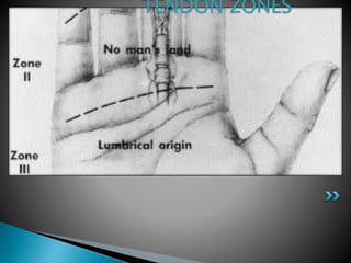 TENDON ZONES
 