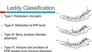 Leddy Classification
 Type I: Retraction into palm
 Type II: Retraction to PIP level
 Type III: Bony avulsion (tendon
attached)
 Type IV: fracture and avulsion of
 