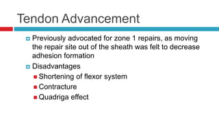 Tendon Advancement
 Previously advocated for zone 1 repairs, as moving
the repair site out of the sheath was felt to decrease
adhesion formation
 Disadvantages
 Shortening of flexor system
 Contracture
 Quadriga effect
 