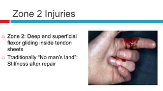 Zone 2 Injuries
 Zone 2: Deep and superficial
flexor gliding inside tendon
sheets
 Traditionally “No man’s land”:
Stiffness after repair
 