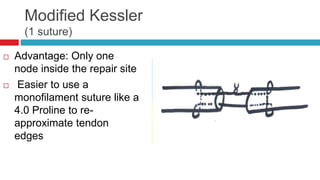 Modified Kessler
(1 suture)
 Advantage: Only one
node inside the repair site
 Easier to use a
monofilament suture like a
4.0 Proline to re-
approximate tendon
edges
 