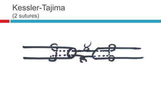 Kessler-Tajima
(2 sutures)
 