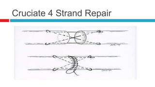 Cruciate 4 Strand Repair
 