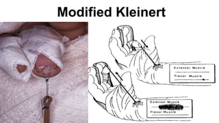 Modified Kleinert
 