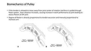 Biomechanics of Pulley
• If the tendon is allowed to move away from joint center of rotation and force is pulled through
flexor system , lever distance increases, causing increase in work performance at joint leading to
excess flexion at DIP joint
• Degree of flexion is directly proportional to tendon excursion and inversely proportional to
moment arm
 