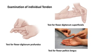 Test for flexor digitorum profundus
Test for flexor digitorum superficialis
Test for flexor pollicis longus
Examination of individual Tendon
 