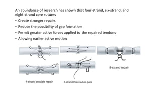 An abundance of research has shown that four-strand, six-strand, and
eight-strand core sutures
• Create stronger repairs
• Reduce the possibility of gap formation
• Permit greater active forces applied to the repaired tendons
• Allowing earlier active motion
 