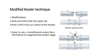 Modified Kessler technique
• Modifications:
Only one knot inside the repair site
Knot is left in the cut surface of the tendon
• Easier to use a monofilament suture like a
4.0 Prolene to reapproximate tendon edges
 