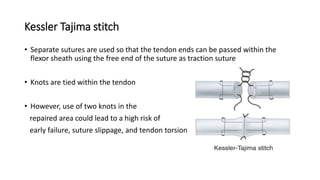 Kessler Tajima stitch
• Separate sutures are used so that the tendon ends can be passed within the
flexor sheath using the free end of the suture as traction suture
• Knots are tied within the tendon
• However, use of two knots in the
repaired area could lead to a high risk of
early failure, suture slippage, and tendon torsion
 